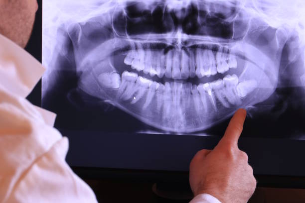 Best Emergency Tooth Extraction in Verandah, FL