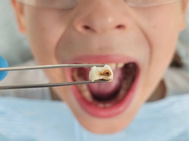 Best Emergency Dental Surgery in Verandah, FL