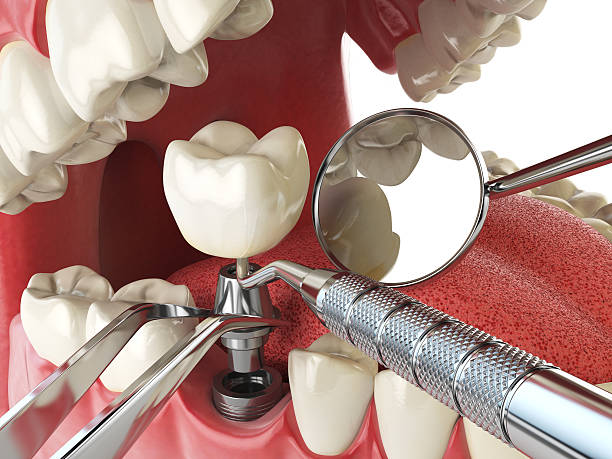 Best Emergency Treatment for Toothache in Verandah, FL